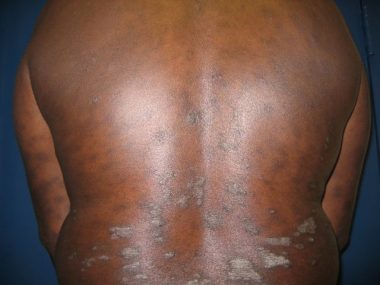 Diagnosing and Treating Psoriasis in Skin of Color-banner-image