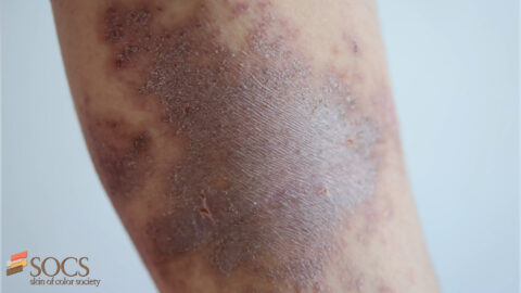 Dermatologic Differences in Darker Skin